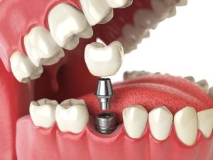 toronto dental implants